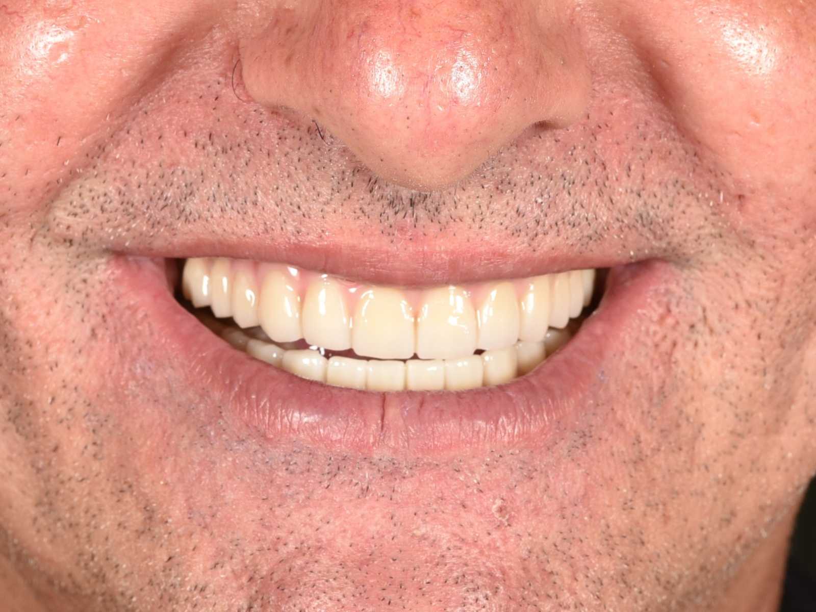 Implanturi orale speciale.