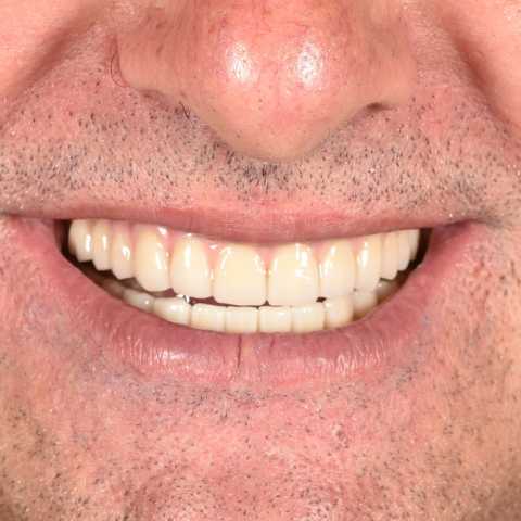 Implanturi orale speciale