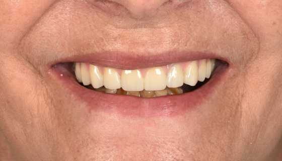 Implanturi orale speciale