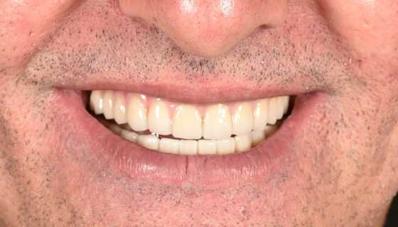 Implanturi orale speciale