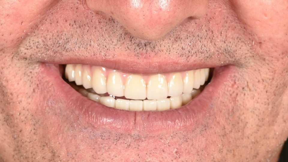 Implanturi orale speciale