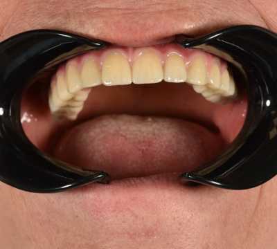All on 6, implanturi orale speciale pterigoide