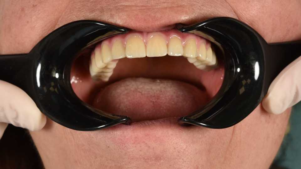 All on 6, implanturi orale speciale pterigoide
