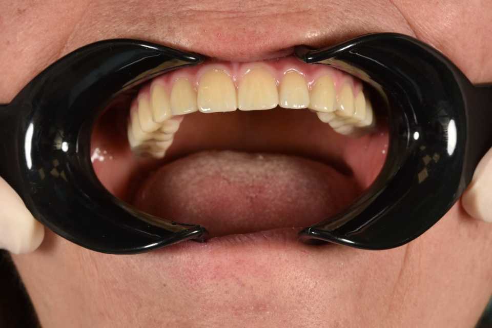 All on 6, implanturi orale speciale pterigoide
