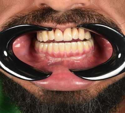 All on 6 protezate cu ajutoul unei lucrări din zirconiu pe suport de titan