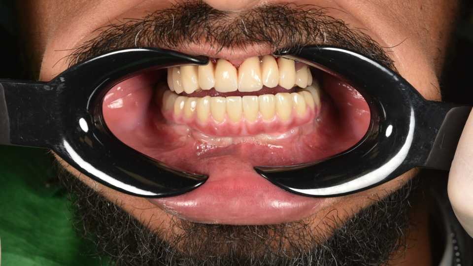 All on 6 protezate cu ajutoul unei lucrări din zirconiu pe suport de titan