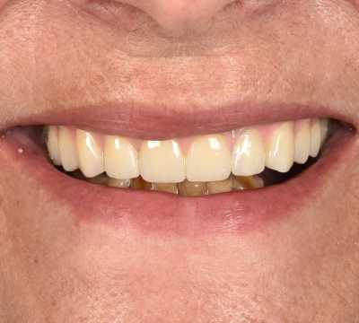 All on 6 cu implanturi orale speciale pterigoide, lucrare protezată din zirconiu pe suport de titan înșurubabilă