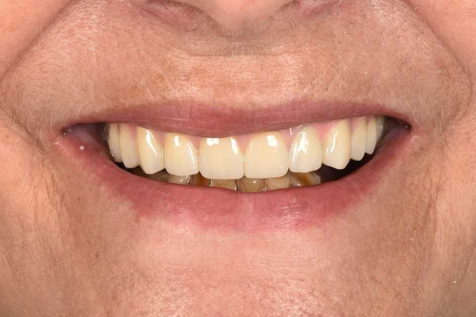 All on 6 cu implanturi orale speciale pterigoide, lucrare protezată din zirconiu pe suport de titan înșurubabilă