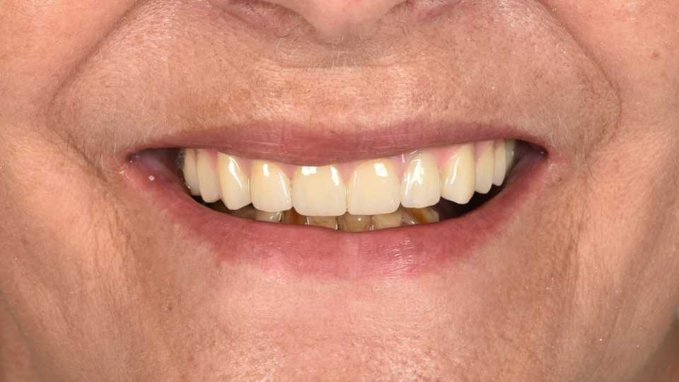 All on 6 cu implanturi orale speciale pterigoide, lucrare protezată din zirconiu pe suport de titan înșurubabilă