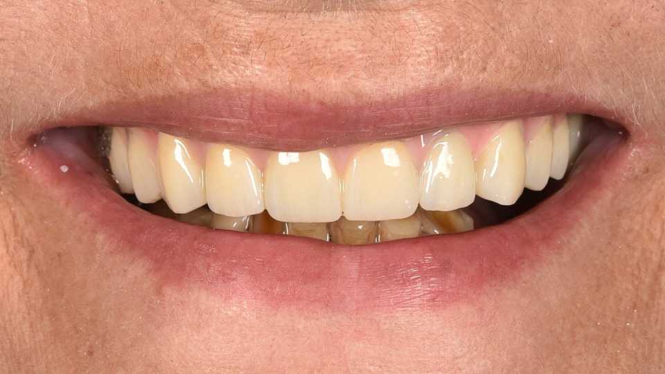 Reabilitare maxilară totală All-on-6 cu implanturi pterigoide MegaGen AnyRidge