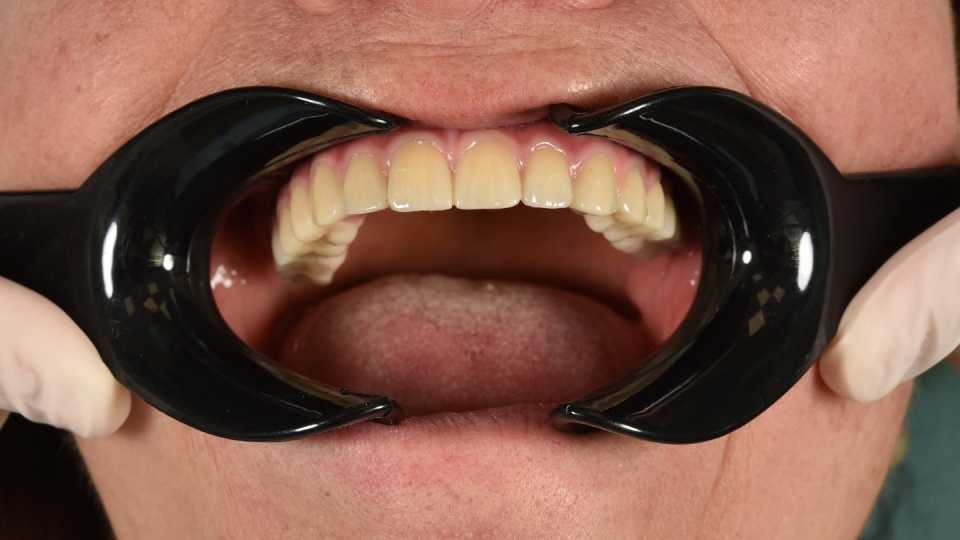 Reabilitare maxilară totală All-on-6 cu implanturi pterigoide