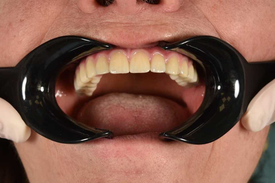 Reabilitare maxilară totală All-on-6 cu implanturi pterigoide