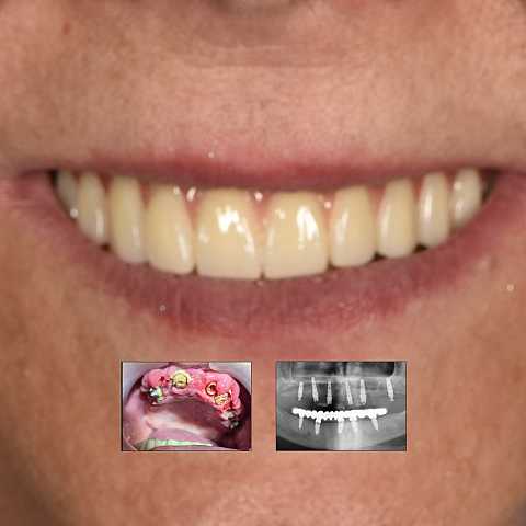 Reabilitare fixă maxilară All-on-6 cu lucrare din zirconiu pe suport de titan