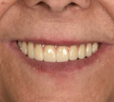 Reabilitare fixă maxilară All-on-6 cu lucrare din zirconiu pe suport de titan