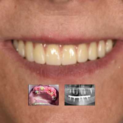 Reabilitare fixă maxilară All-on-6 cu lucrare din zirconiu pe suport de titan
