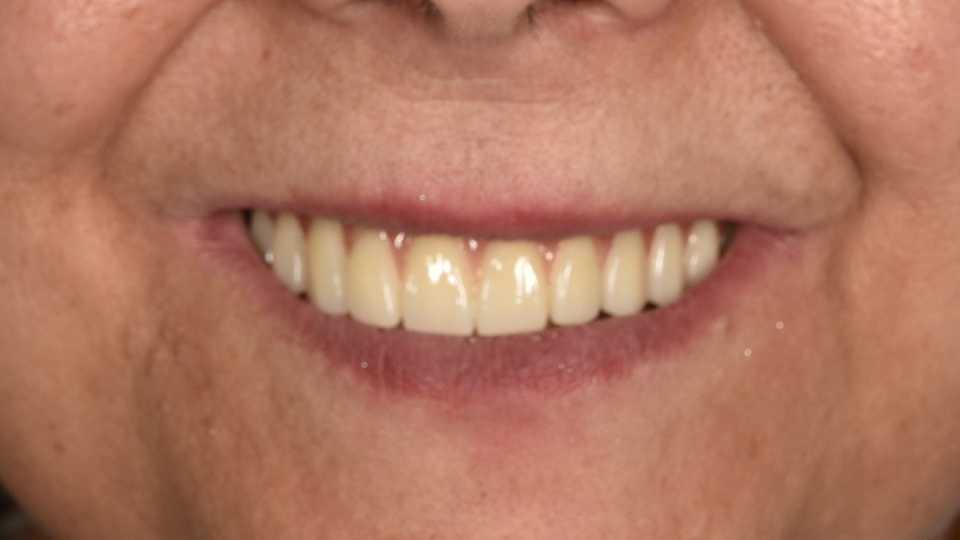 Reabilitare fixă maxilară All-on-6 cu lucrare din zirconiu pe suport de titan