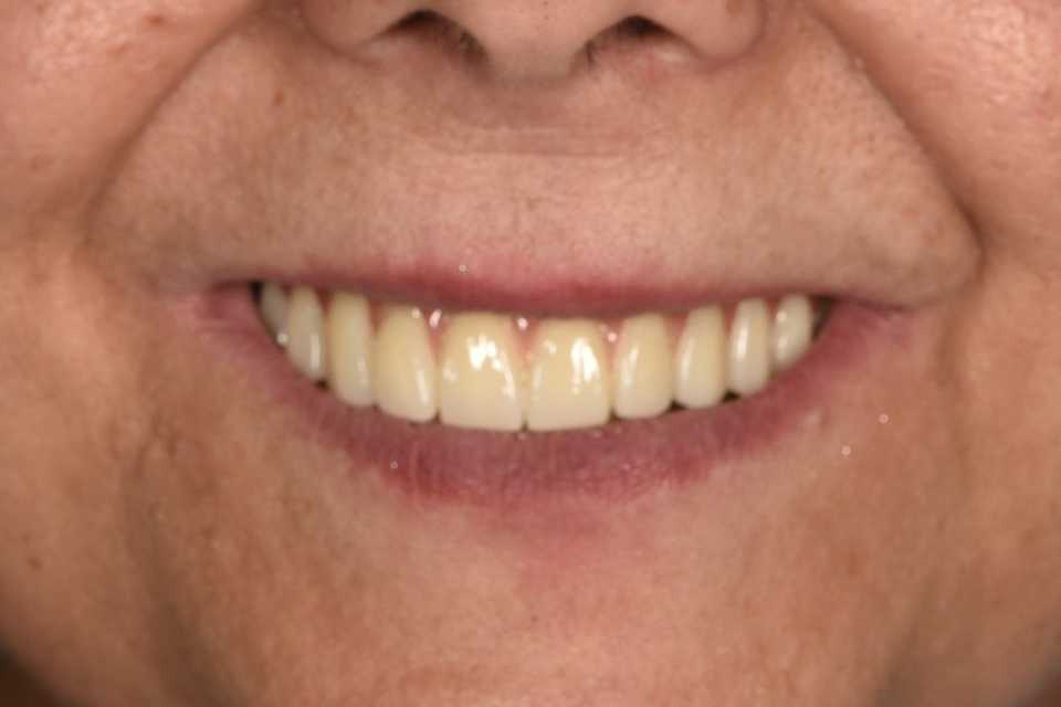 Reabilitare fixă maxilară All-on-6 cu lucrare din zirconiu pe suport de titan
