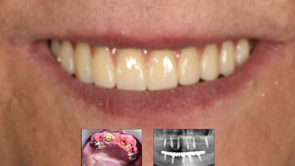 Reabilitare fixă maxilară All-on-6 cu lucrare din zirconiu pe suport de titan