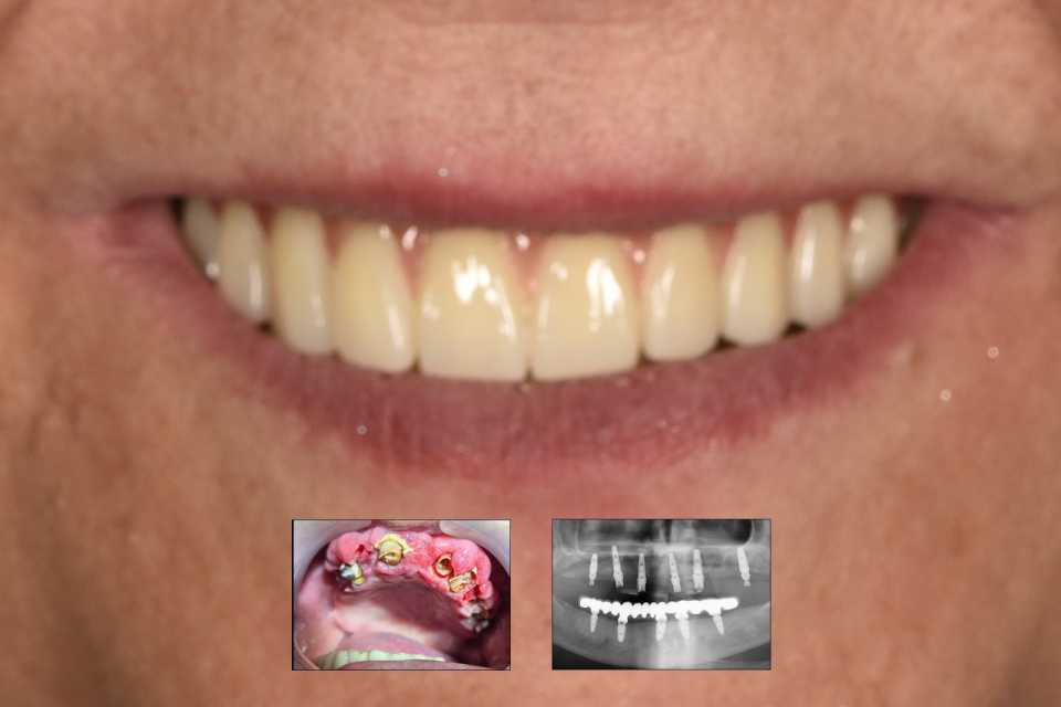 Reabilitare fixă maxilară All-on-6 cu lucrare din zirconiu pe suport de titan
