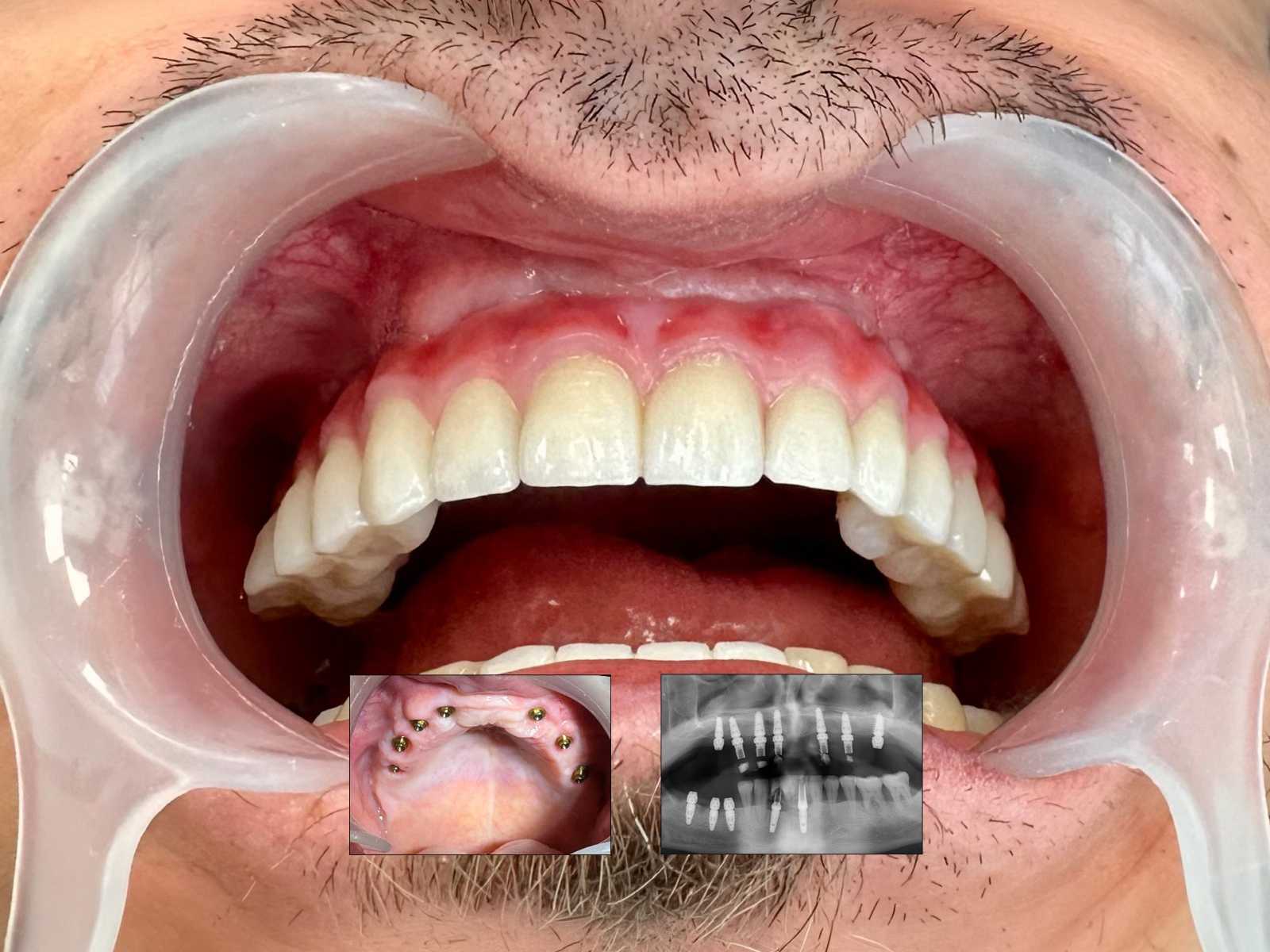 Reconstrucție osoasă pentru implanturi dentare.