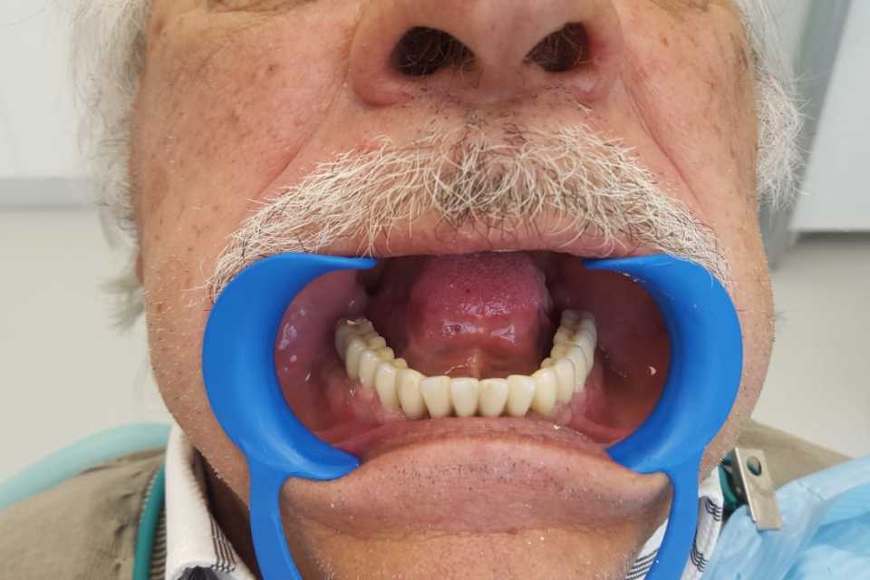 Protezare fixă cu ajutorul implanturilor dentare 1