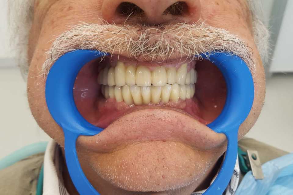 Protezare fixă cu ajutorul implanturilor dentare 2
