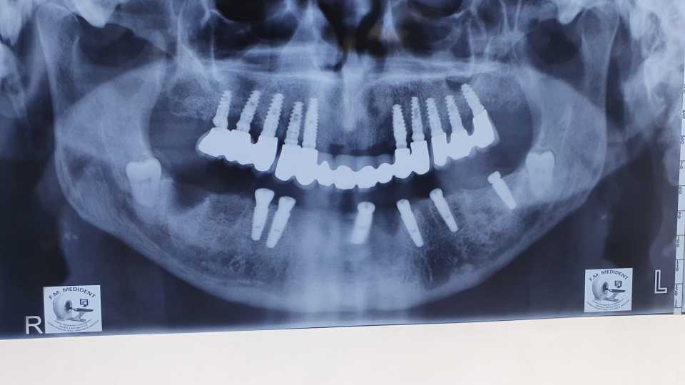 Protezare fixă cu ajutorul implanturilor dentare 3
