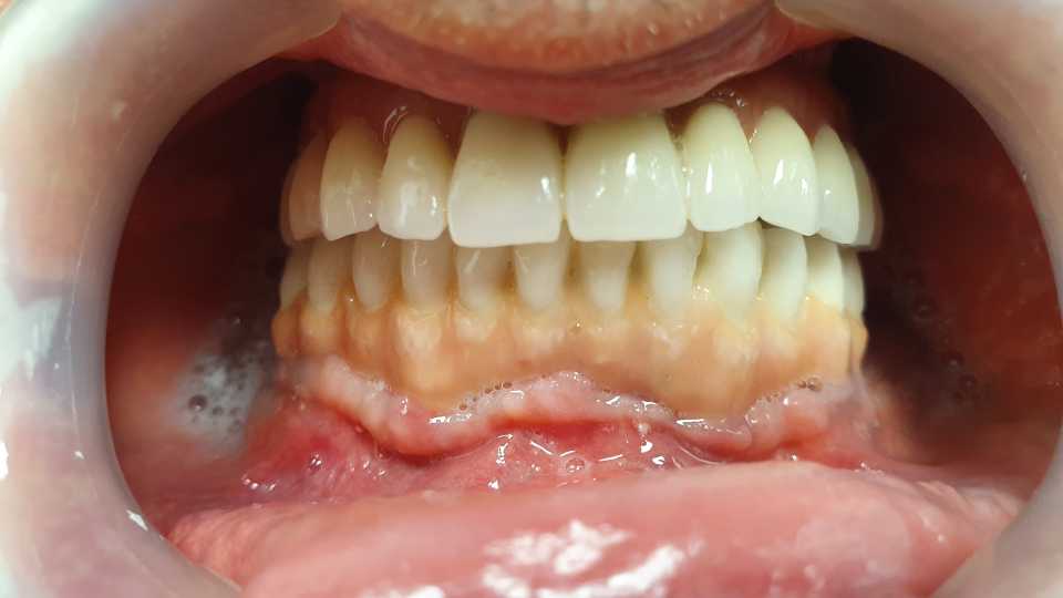 Sinus lifting, implanturi și adiții osoase 1