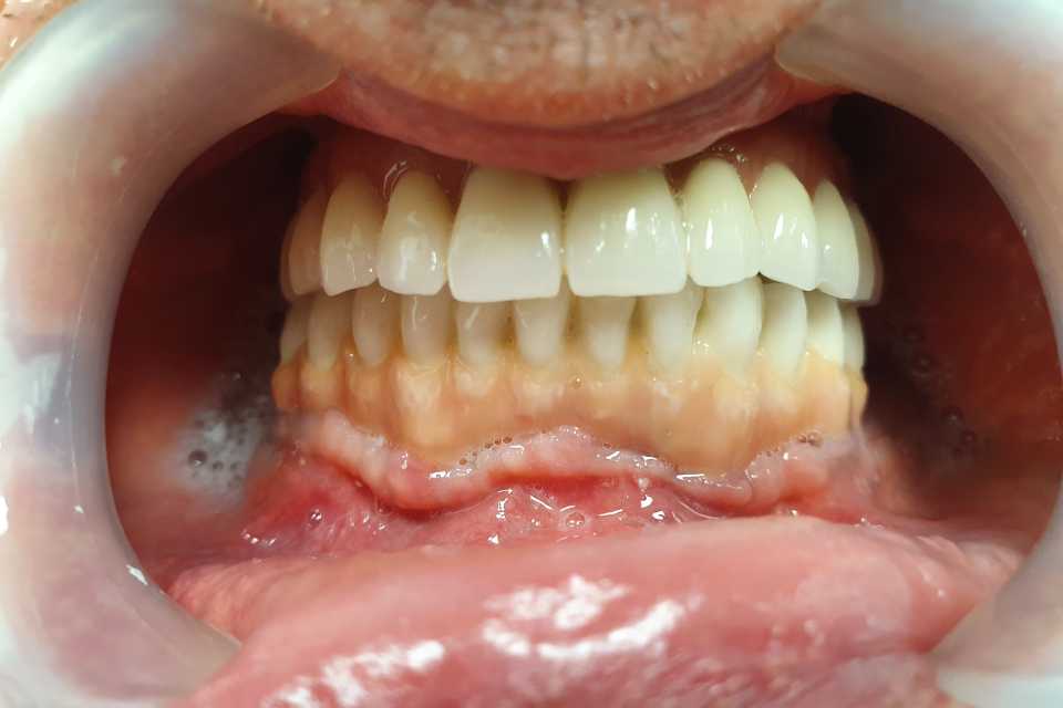 Sinus lifting, implanturi și adiții osoase 1