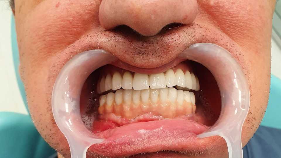 Sinus lifting, implanturi și adiții osoase 2