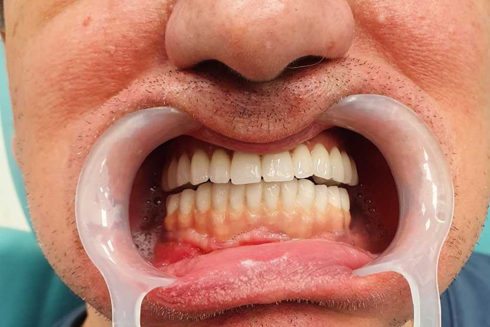 Sinus lifting, implanturi și adiții osoase 2