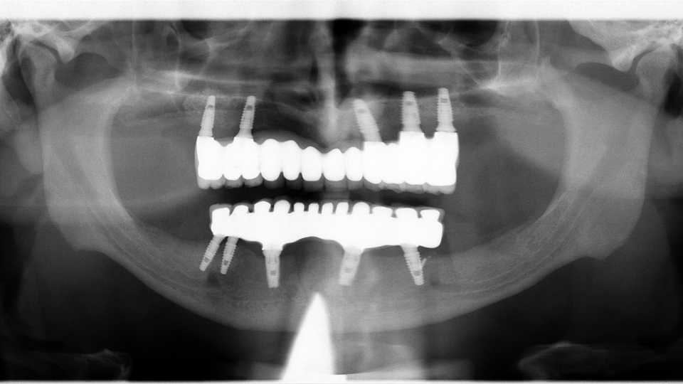 Sinus lifting, implanturi și adiții osoase 3