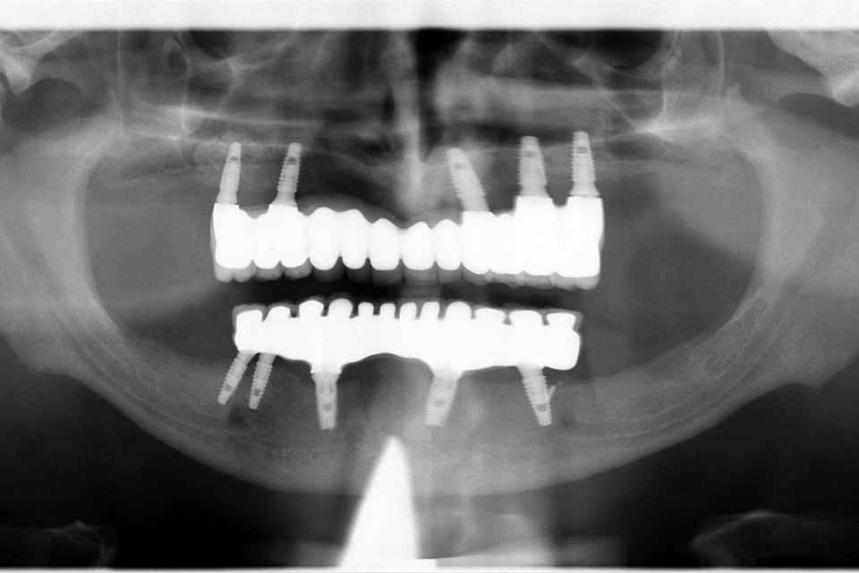 Sinus lifting, implanturi și adiții osoase 3