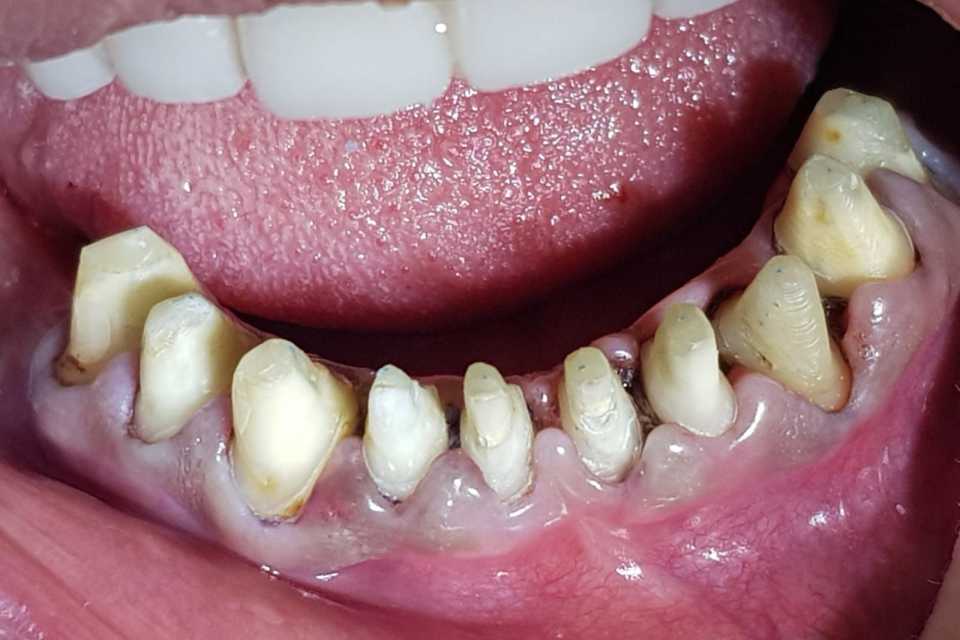 Coroane ceramice Emax 3