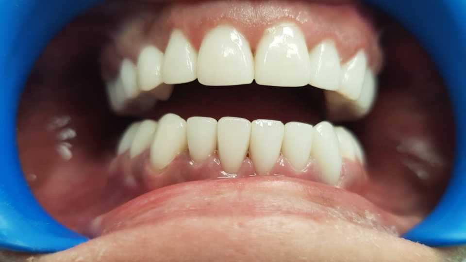 Coroane ceramice Emax 2