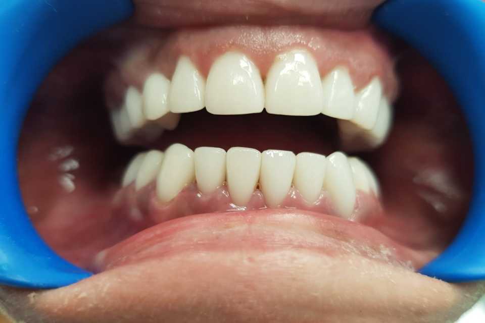 Coroane ceramice Emax 2