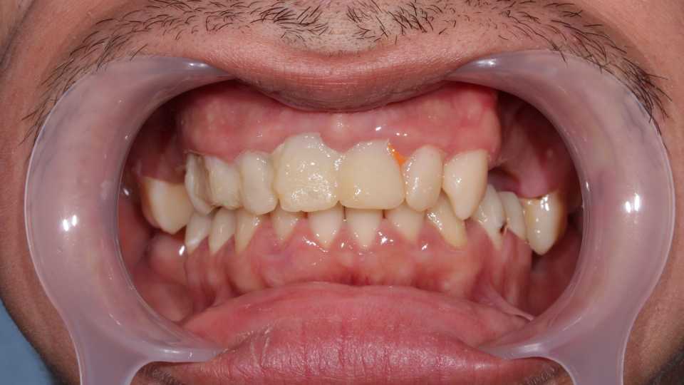 Coroane și punți din ceramică pe substrat de zirconiu 1