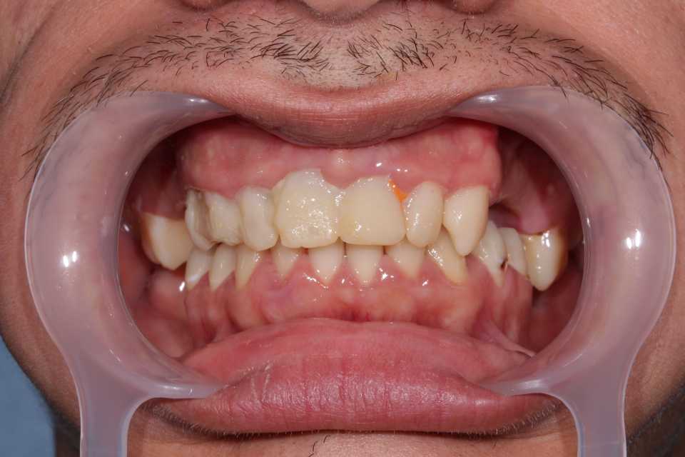 Coroane și punți din ceramică pe substrat de zirconiu 1