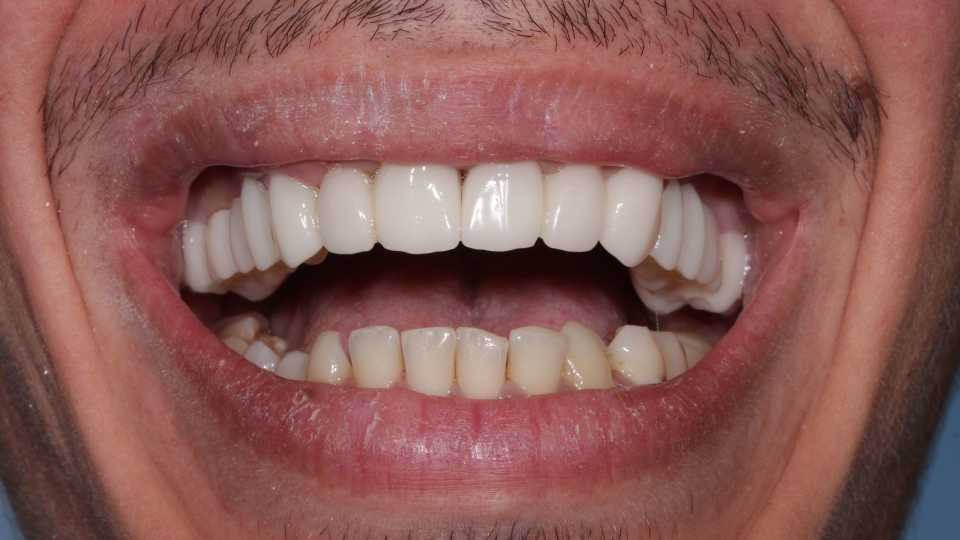 Coroane și punți din ceramică pe substrat de zirconiu 2