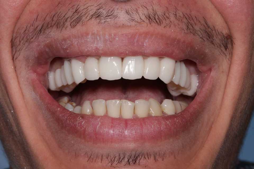 Coroane și punți din ceramică pe substrat de zirconiu 2