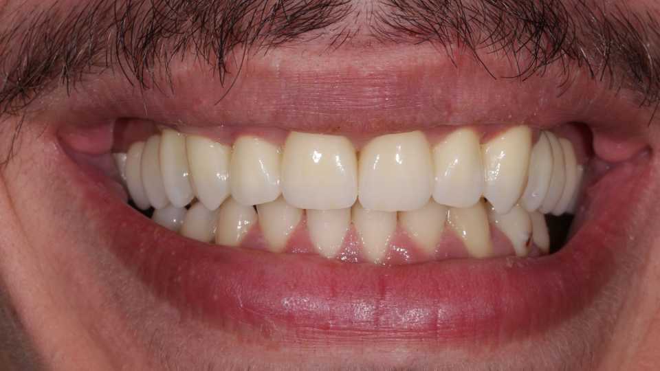 Coroane și punți din ceramică pe substrat de zirconiu 3