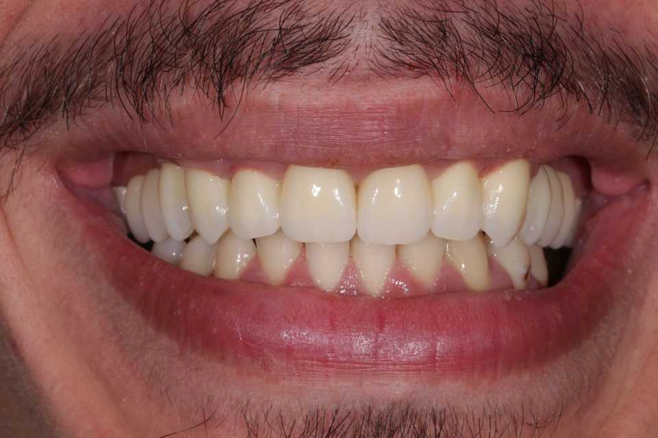 Coroane și punți din ceramică pe substrat de zirconiu 3