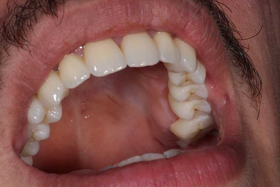 Coroane și punți din ceramică pe substrat de zirconiu 4