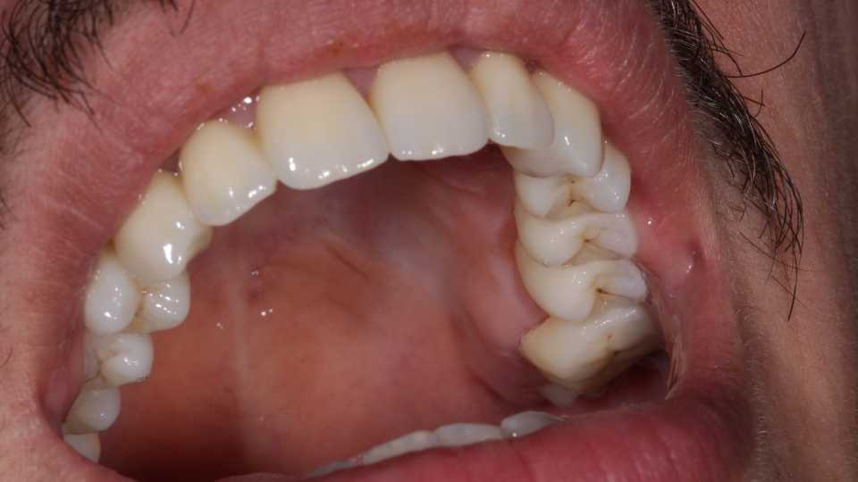 Coroane și punți din ceramică pe substrat de zirconiu 4