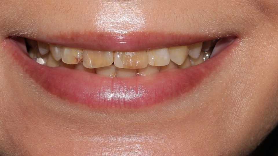 coroane din ceramica pe suport de zirconiu 1
