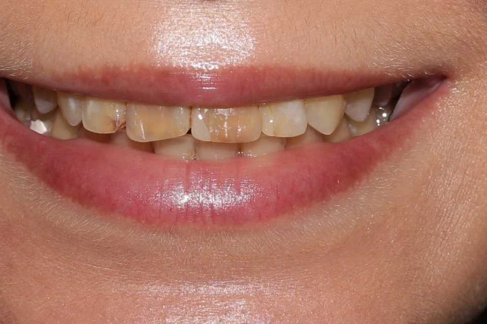 coroane din ceramica pe suport de zirconiu 1
