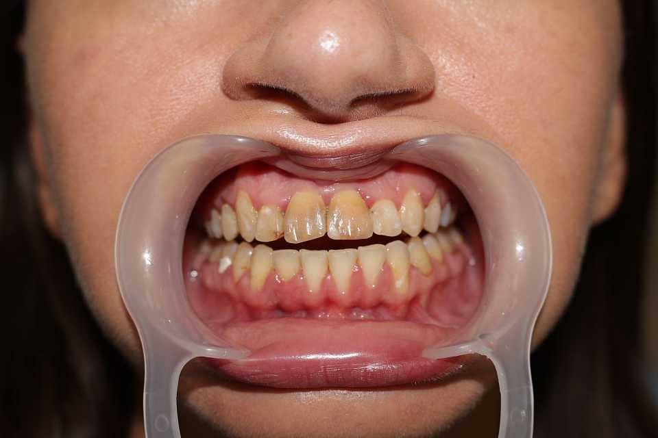 coroane din ceramica pe suport de zirconiu 2