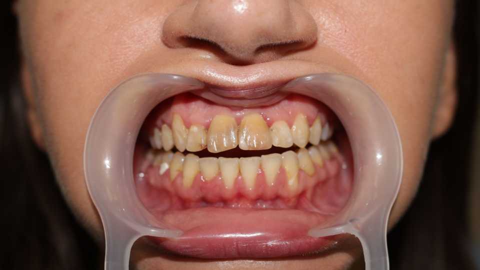 coroane din ceramica pe suport de zirconiu 2