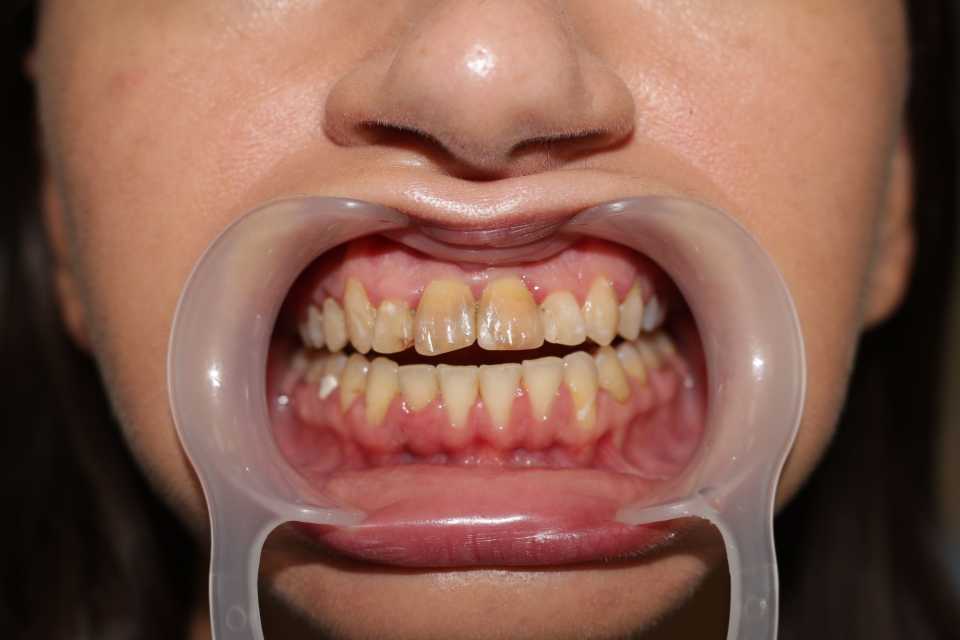 coroane din ceramica pe suport de zirconiu 2