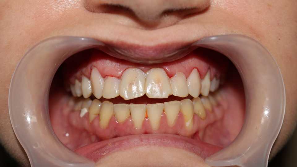 coroane din ceramica pe suport de zirconiu 3